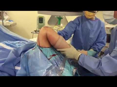 Cum să restabiliți cartilajul în articulația genunchiului