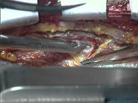 Dissection de l'artère mammaire interne