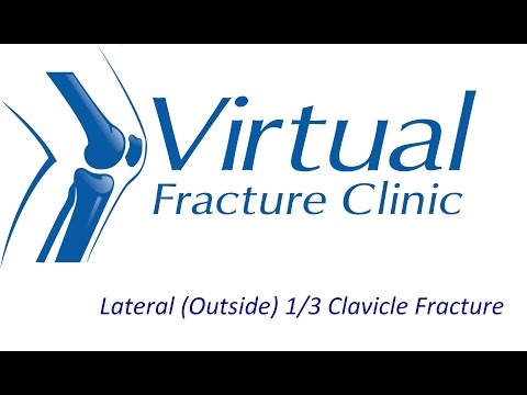 Lateral (Outside) 1/3 Clavicle Fracture