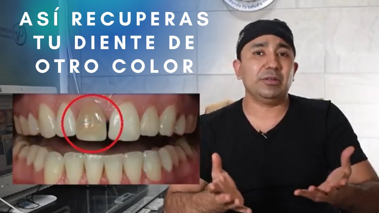 Watch ¿Tienes un diente de otro color ¿Cuál es la SOLUCIÓN Now ¿Tienes un diente de otro color ¿Cuál es la SOLUCIÓN