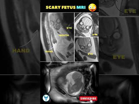 Baby MRI | Fetal scan | Pregnancy week by week #pregnancy #mri #sonography