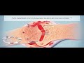 HUMIRA® (adalimumab) Mechanism of Action in Psoriatic Arthritis