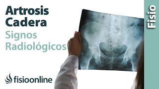 Artrosis de cadera - Signos radiológicos