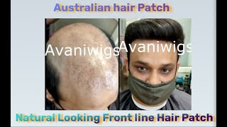 Non surgical hair replacement for men