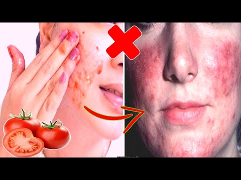 download lagu mp3 mp4 Tomato On Face Side Effects, download lagu Tomato On Face Side Effects gratis, unduh video klip Tomato On Face Side Effects
