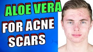 How To Use Aloe Vera OVERNIGHT To Treat Acne Scars, Pimples & Zits