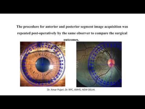 Smartphone- Based Evaluation Of The Iris And Fundal Torsion In Strabismus Patients