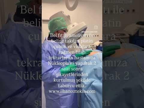 Bel fıtığında platin çubuk ve vidalara rağmen Nükleoplasti işlemi