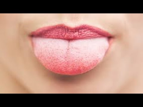 ✅ O que fazer quando queimar a língua?