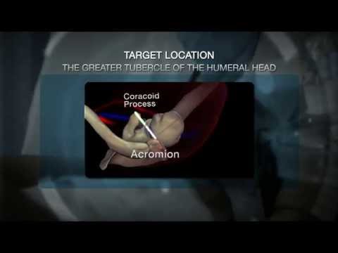 The NIO™: Location – Humerus
