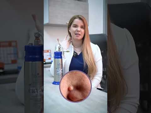 Criogenesis en Barranquilla por la dermatóloga Erika Ariza