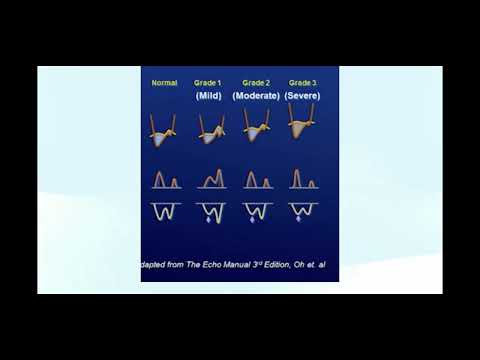Measuring and Grading Diastolic Dysfunction using Echocardiography - Diastology!