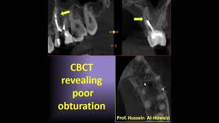 Endodontic retreatment and obturation of lateral canal.