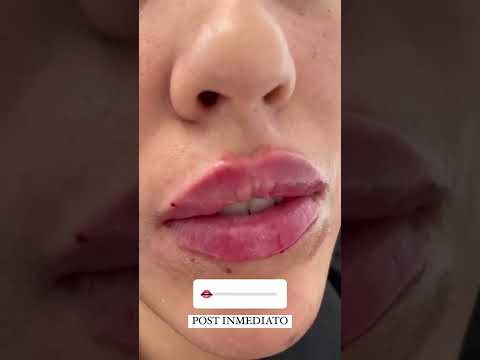 Relleno de Labios