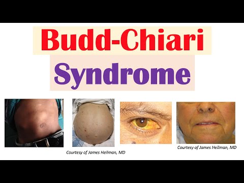 Irritable Bowel Syndrome IBS Causes Symptoms Bristol Stool Chart Types and Treatment