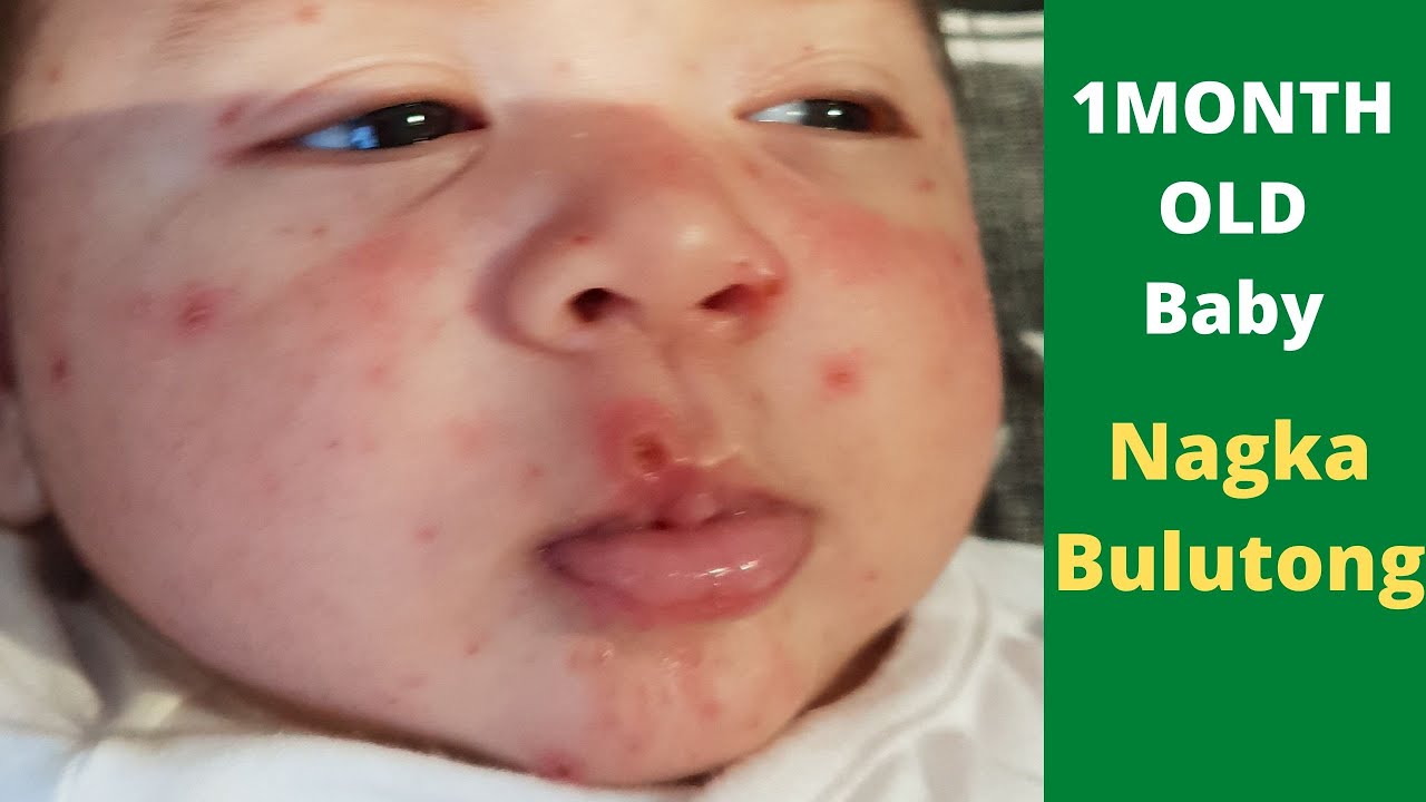 BULUTONG TUBIG OR CHICKEN POX I GAMOT SA BULUTONG TUBIG