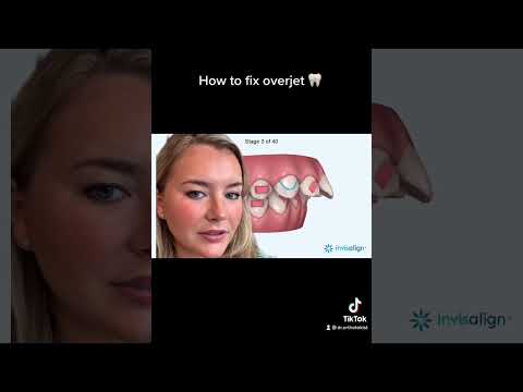 Fixing overjet #shorts #braces