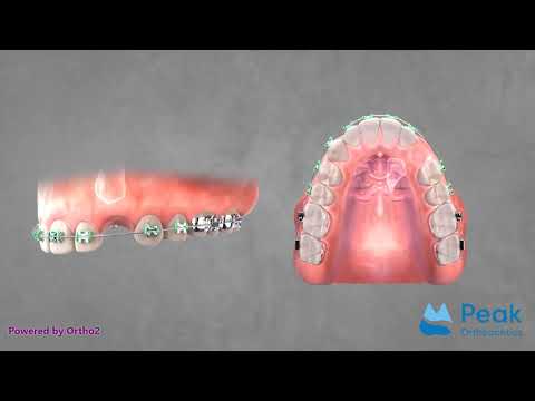 Impacted canine - gold chain