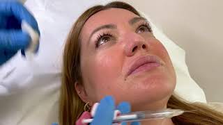 Hidratación de Labios con Ácido Hialurónico