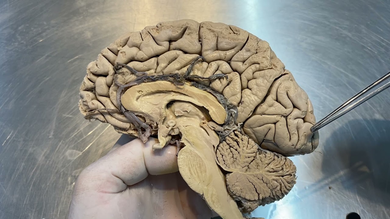 Vascularização Encefálica - Círculo arterial cerebral (Polígono de Willis)