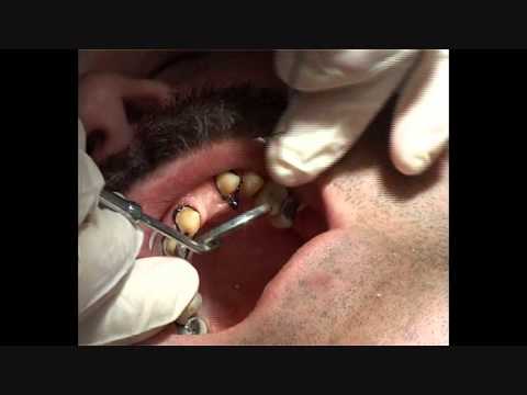 Impression Techniques for Fixed Prosthodontics patients