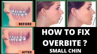 HOW TO FIX OVERBITE & Small chin + WITH NO BRACES
