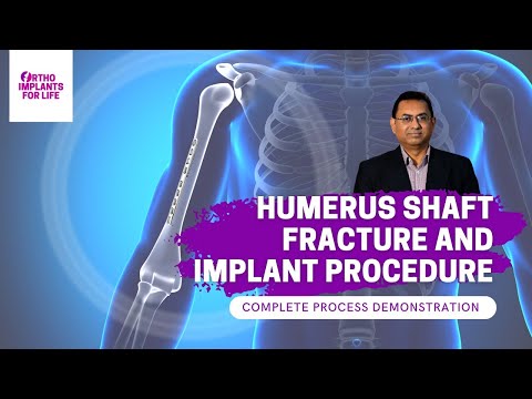 Humerus Shaft Fracture Implant and Instrument Demonstration