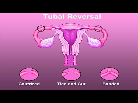 Watch Tubal Ligation Reversal in Mexico