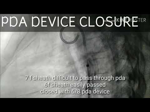 PDA (Patent ductus arteriosus) device closure | Congenital heart disease