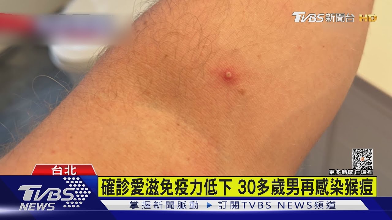 猴痘國內死亡首例!30多歲男確診51天後不治