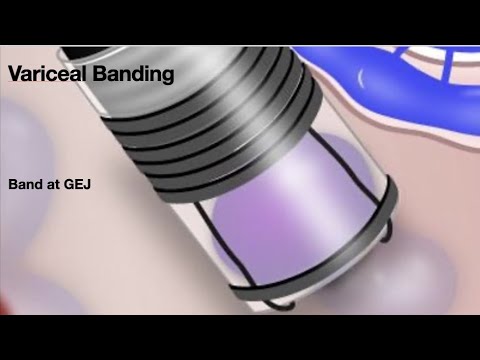 HCC 1475-27  Band ligator