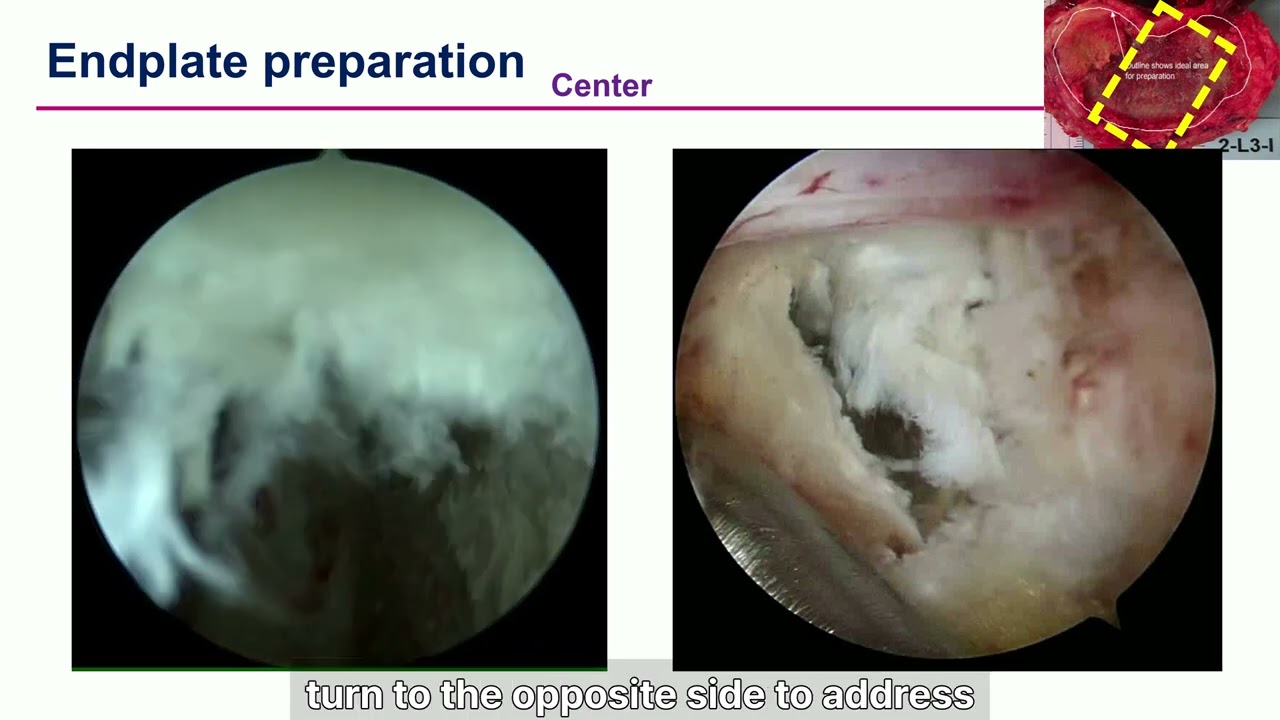 BE-LIF Surgery Thumbnail