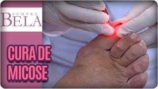 Tratamento de Micose com Laser - Sempre Bela (12/11/17)