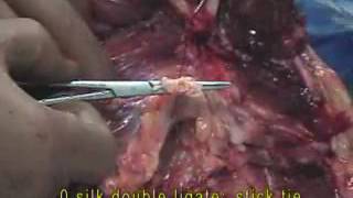 Transfemoral Amputation 2 - Vessels