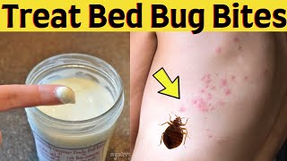 How To Treat Bed Bug Bites, Itch On Skin At Home Fast and Easily – Relieve Bed Bug Bites