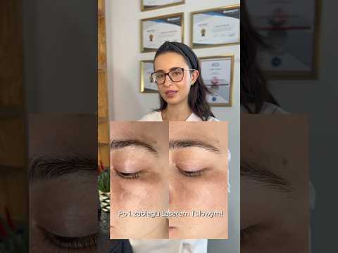 Czy jeden zabieg laserowy rozjaśni przebarwienia?