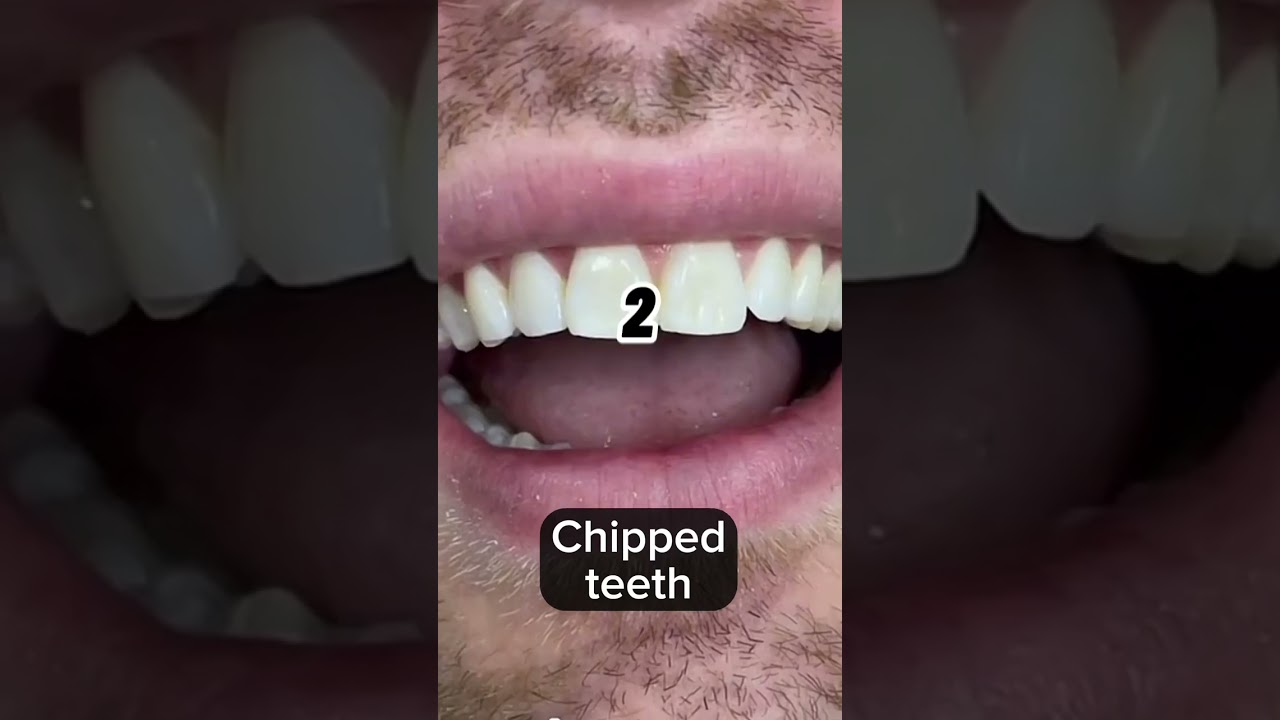 Signs you need braces #shorts