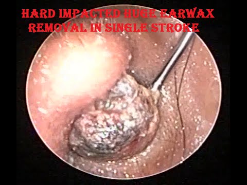 Hard Impacted Huge Ear Wax removal in single stroke