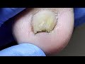Complex Onychomycosis Trimmed Layer By Layer