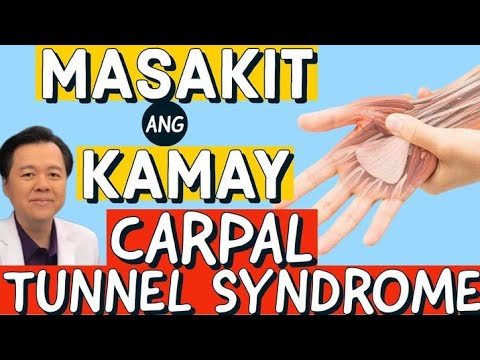 Masakit ang Kamay: Carpal Tunnel Syndrome. - By Doc Willie Ong (Internist and Cardiologist)