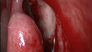 DACRIOCISTITA DACRIOCISTORINOSTOMIE ENDOSCOPICA TRANSNAZALA 2