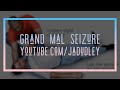 Grand mal seizure