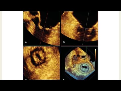 Assessment of Rheumatic Mitral Stenosis by Transesophageal Echocardiography (TEE)