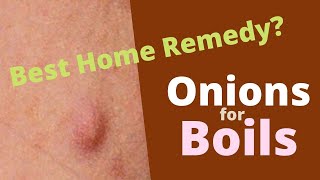 Onions for Boils- Excellent Natural Remedy for Skin Abscess