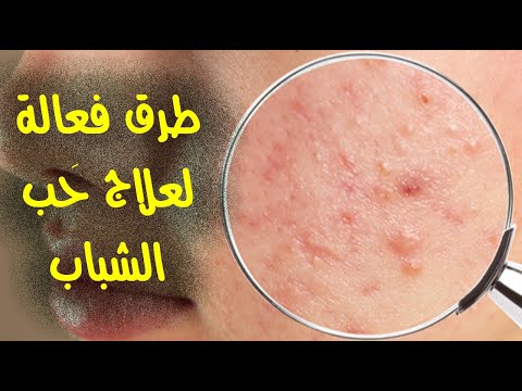 طرق فعالة لعلاج حَب الشباب