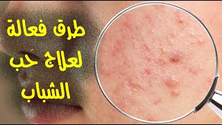 طرق فعالة لعلاج حَب الشباب طرق فعالة لعلاج حَب الشباب