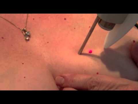 comment traiter angiome