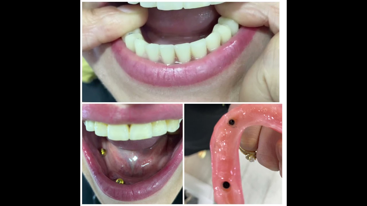 Attachement avec deux implants pour stabiliser une prothèse totale inférieure