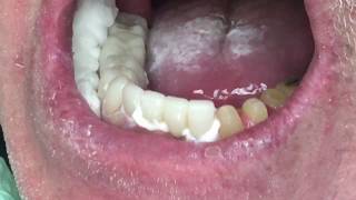 Houston Cosmetic Dentist ...Watch this Amazing Smile Makeover Step by Step