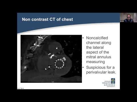 Difficult Occluder Cases